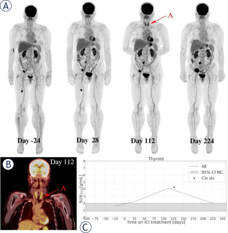 Role of quantitative imaging biomarkers in an early FDG-PET/CT for ...