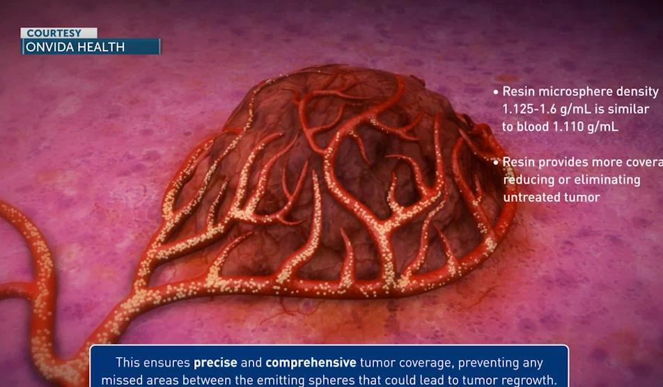 New milestone for liver cancer patients - NewsBreak