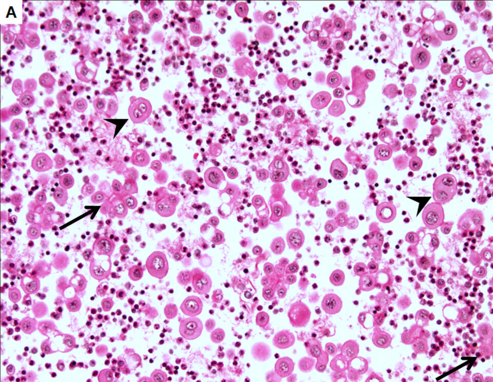 Adenocarcinoma cells in effusion cytology as a diagnostic pitfall with ...
