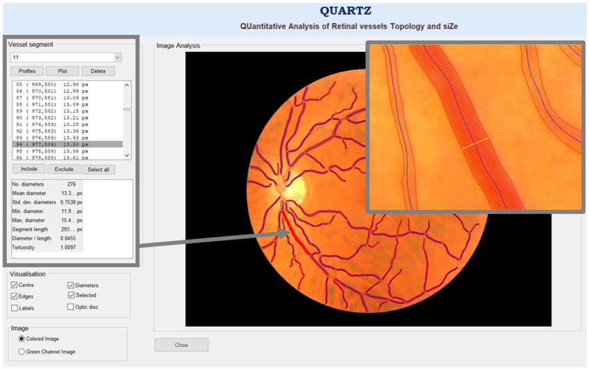 Certain Retinal Vessel Traits May Signal Balance Impairment - NewsBreak