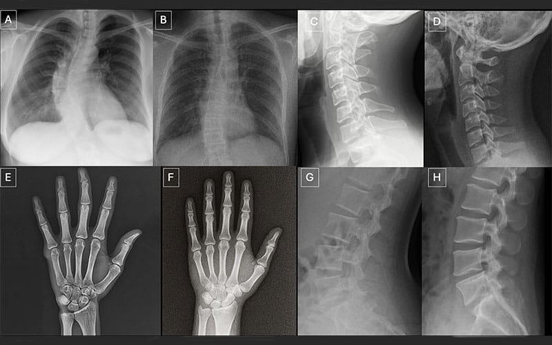 Study on Radiologists’ Difficulty Detecting AI-Generated X-Rays Wins ...