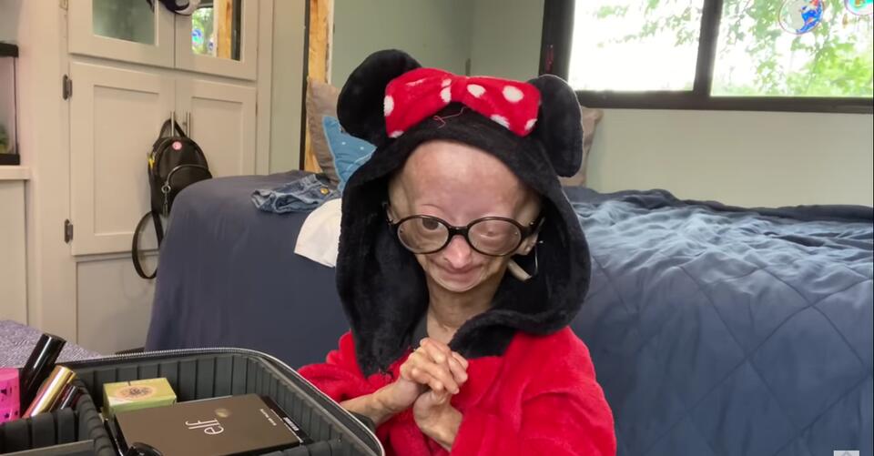 Youtube star with Benjamin Button disease dies at 15 – NewsBreak