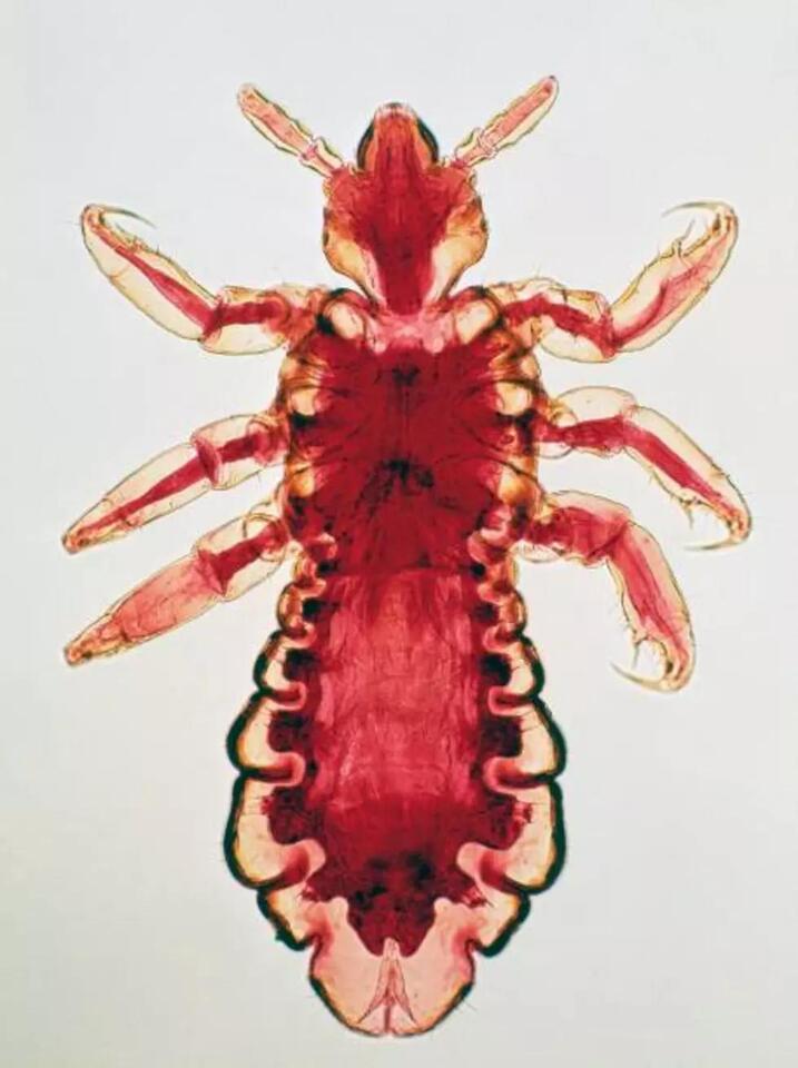 Super Lice Are Here. How Concerned Should New Jersey Parents Be ...