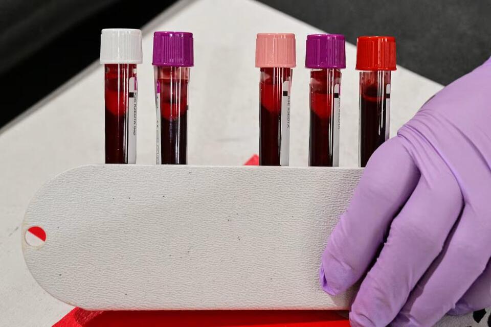 Iron deficiency often goes undiagnosed. New guidelines could change ...