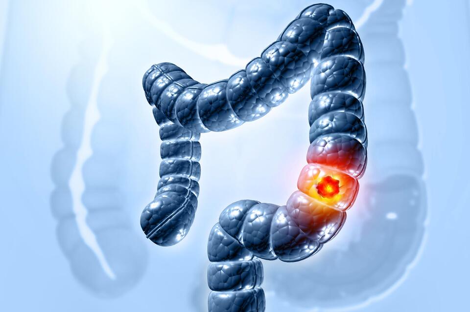 Biologists Discover a Cellular Pathway That Helps Colorectal Cancer ...