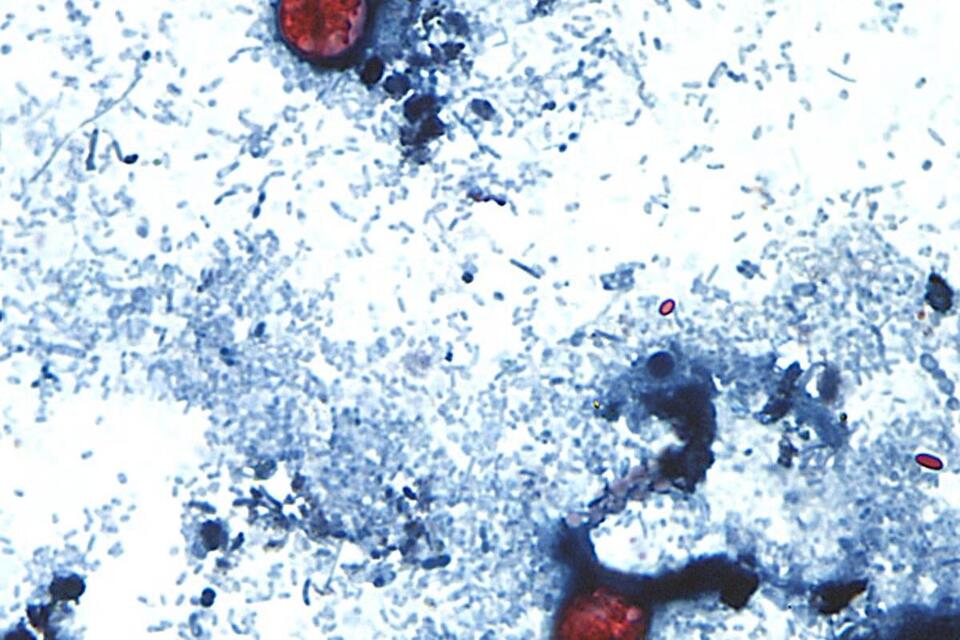Cyclosporiasis outbreak: Symptoms to watch for as ‘explosive diarrhea' cases climb in US