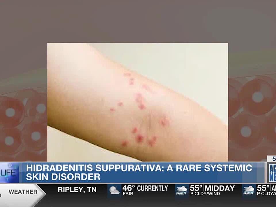 Best Life Hidradenitis suppurativa rare systemic skin disorder