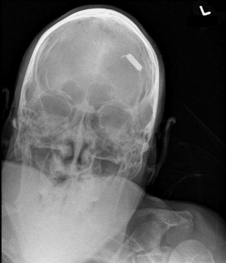 Intracranial Penetrating Taser Dart Injury - NewsBreak
