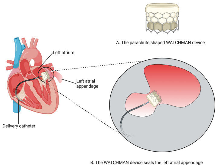 The WATCHMAN Device Review: A New Era for Stroke Prophylaxis - NewsBreak