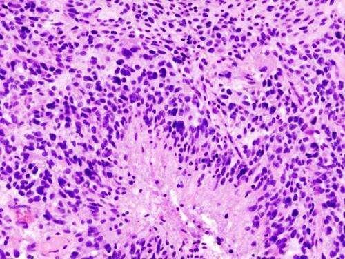 Signaling pathway may help predict immunotherapy response in glioblastoma