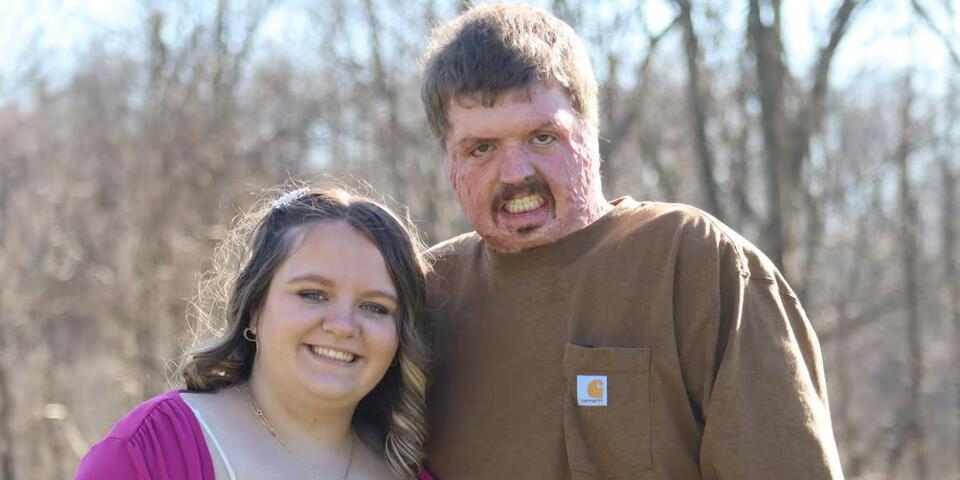 Orphan well explosion survivor shares recovery story - NewsBreak