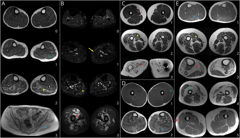 Whole-Body Skeletal Muscle MRI Patterns in Female Dystrophinopathy ...