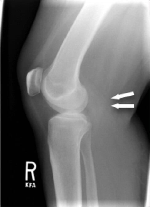 Malignant Tenosynovial Giant Cell Tumor of the Leg: A Radiologic ...