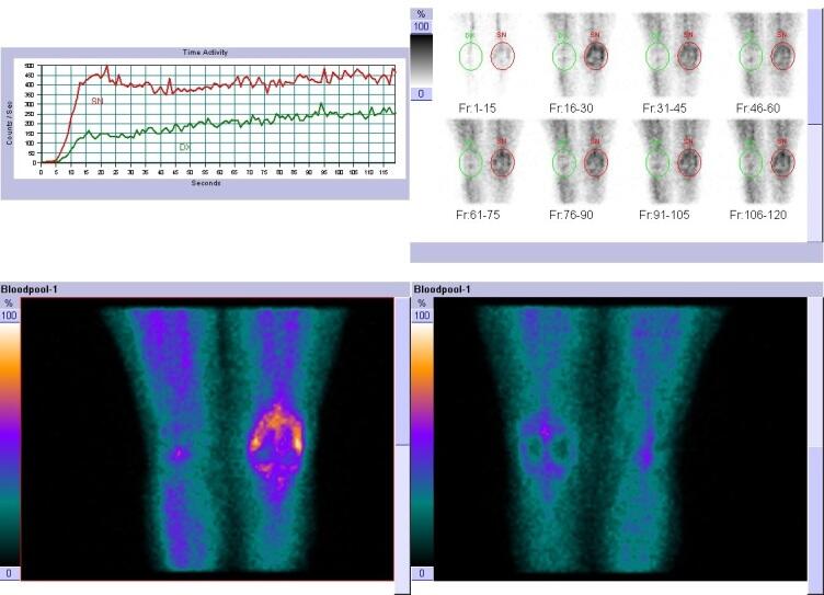 Management of periprosthetic knee joint infections: focus on the role ...