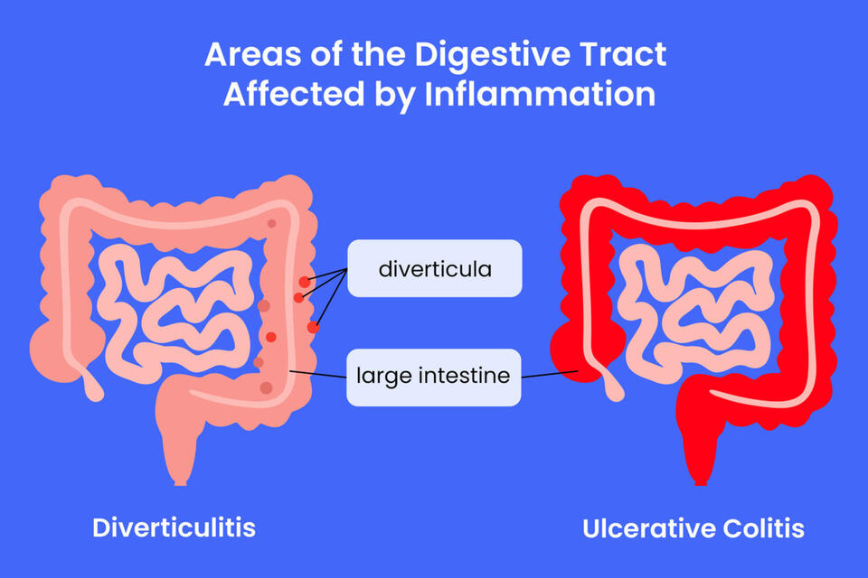 What’s the Difference Between Ulcerative Colitis and Diverticulitis?