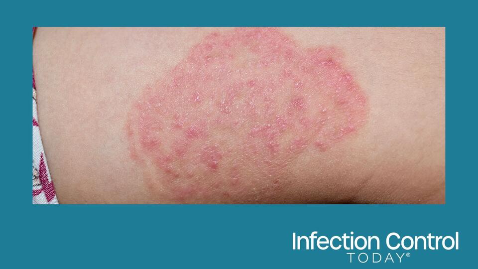 What Is Trichophyton indotineae? Drug-Resistant Ringworm Spreads to 29 ...